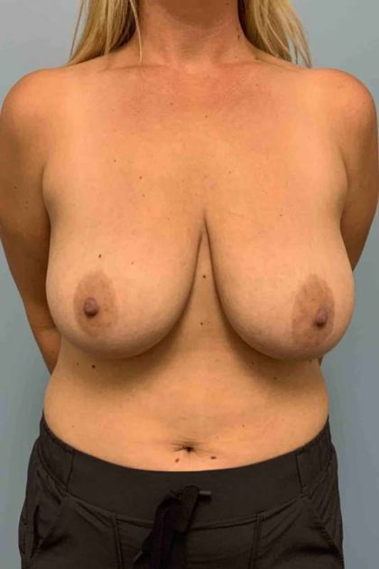 Breast Reduction Before & After Patient #11847