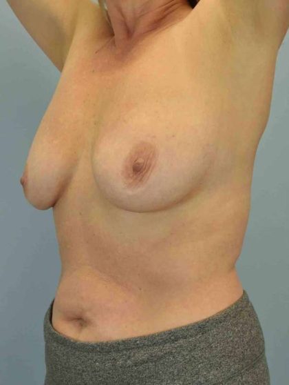 Breast Reconstruction Before & After Patient #11919