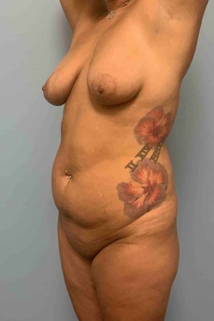 Breast Lift Before & After Patient #11973