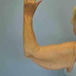 Brachioplasty Before & After Patient #12348