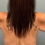 Brachioplasty Before & After Patient #12362