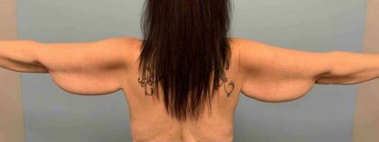 Brachioplasty Before & After Patient #12362