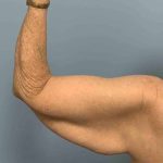 Brachioplasty Before & After Patient #12371