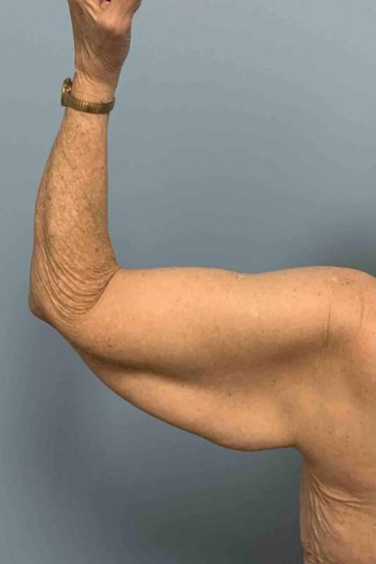 Brachioplasty Before & After Patient #12371