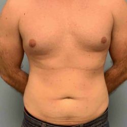 VASER Liposelection Before & After Patient #10434