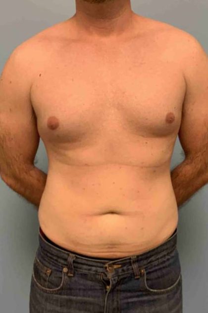 VASER Liposelection Before & After Patient #10434