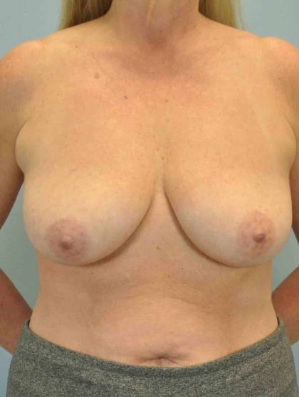Breast Reconstruction Before & After Patient #11919