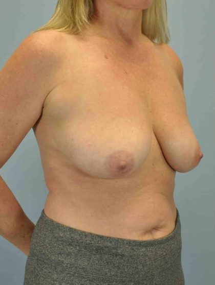 Breast Lift Before & After Patient #12021