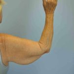 Brachioplasty Before & After Patient #12348
