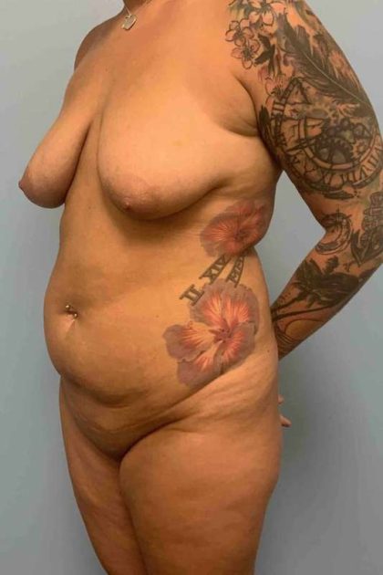 VASER Liposelection Before & After Patient #10479