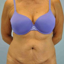 VASER Liposelection Before & After Patient #10511