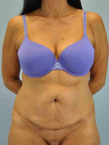 VASER Liposelection Before & After Patient #10511