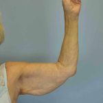 VASER Liposelection Before & After Patient #10615