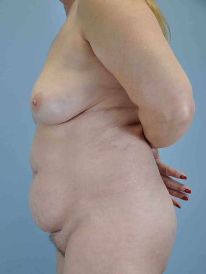 Tummy Tuck Before & After Patient #10714