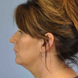 Neck Lift Before & After Patient #11145