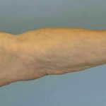 VASER Liposelection Before & After Patient #10615