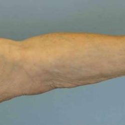 VASER Liposelection Before & After Patient #10615