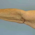 Brachioplasty Before & After Patient #12348