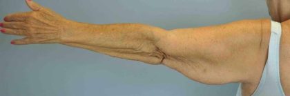 Brachioplasty Before & After Patient #12348