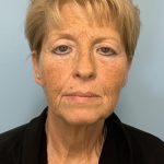 BBL Forever Young Before & After Patient #13684