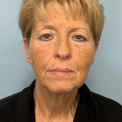 Neck Lift Before & After Patient #11060