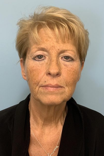 Facelift Before & After Patient #11396