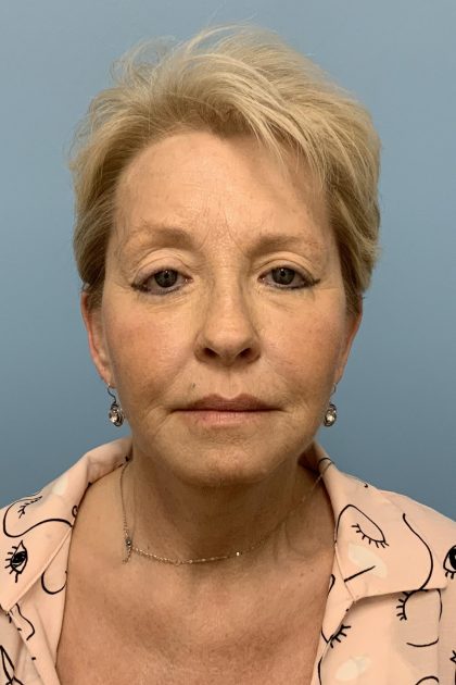 Facelift Before & After Patient #11396