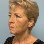 BBL Forever Young Before & After Patient #13684