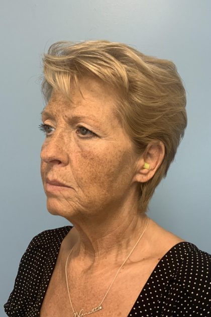 BBL Forever Young Before & After Patient #13684