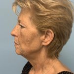 Facelift Before & After Patient #11396