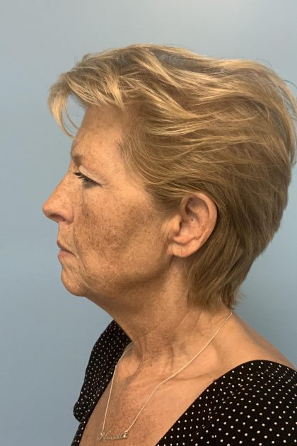 BBL Forever Young Before & After Patient #13684