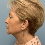 Facelift Before & After Patient #11396