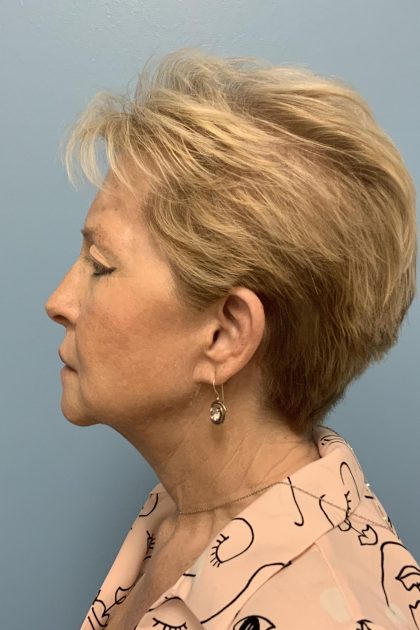 BBL Forever Young Before & After Patient #13684