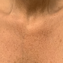 BBL Forever Young Before & After Patient #13684