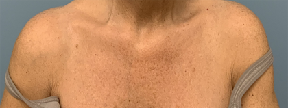 BBL Forever Young Before & After Patient #13684