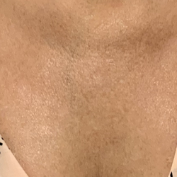 BBL Forever Young Before & After Patient #13684