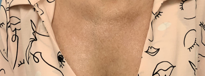 BBL Forever Young Before & After Patient #13684