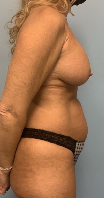 VASER Liposelection Before & After Patient #10643
