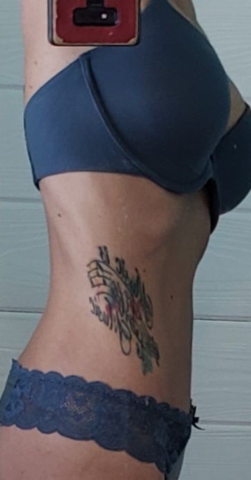 VASER Liposelection Before & After Patient #10643