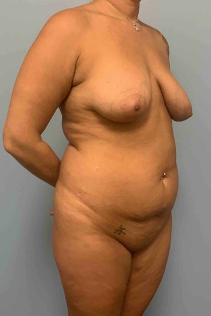 Tummy Tuck Before & After Patient #10816