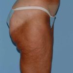 Buttocks Before & After Patient #11711