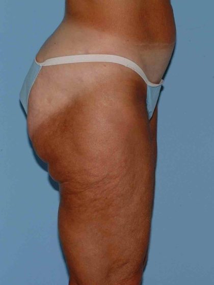 Buttocks Before & After Patient #11711