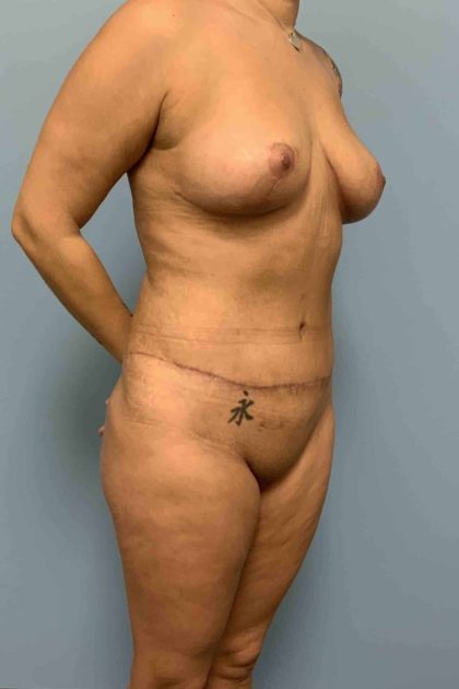 Tummy Tuck Before & After Patient #10816
