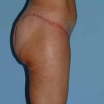 Buttocks Before & After Patient #11711