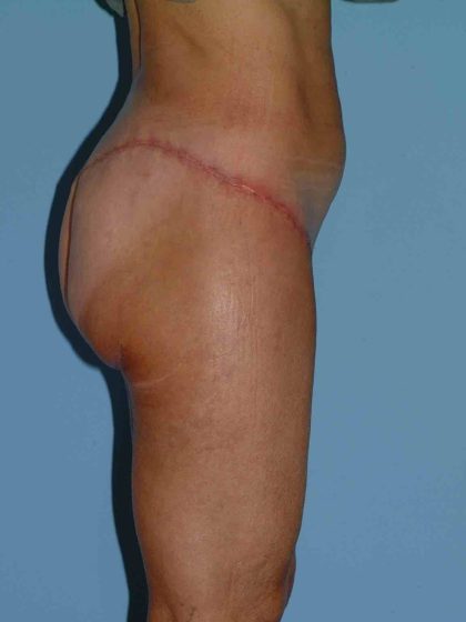 Buttocks Before & After Patient #11711