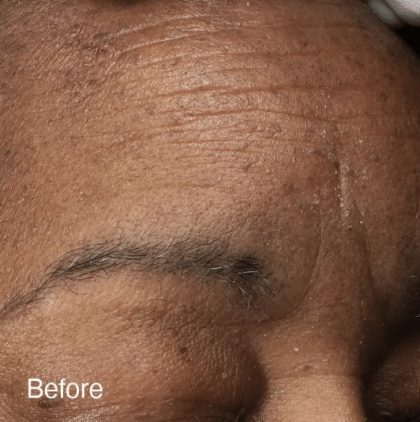 Vivace Ultra Before & After Patient #12804