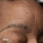 Vivace Ultra Before & After Patient #12804