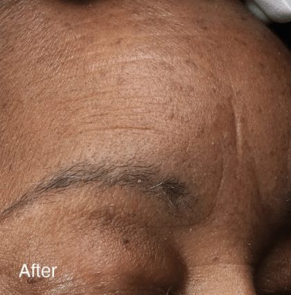 Vivace Ultra Before & After Patient #12804