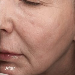Vivace Ultra Before & After Patient #12801