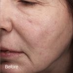 Vivace Ultra Before & After Patient #12801